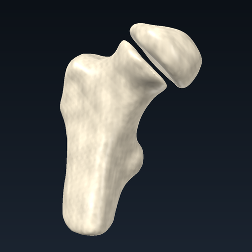 Femur boyun kırığı